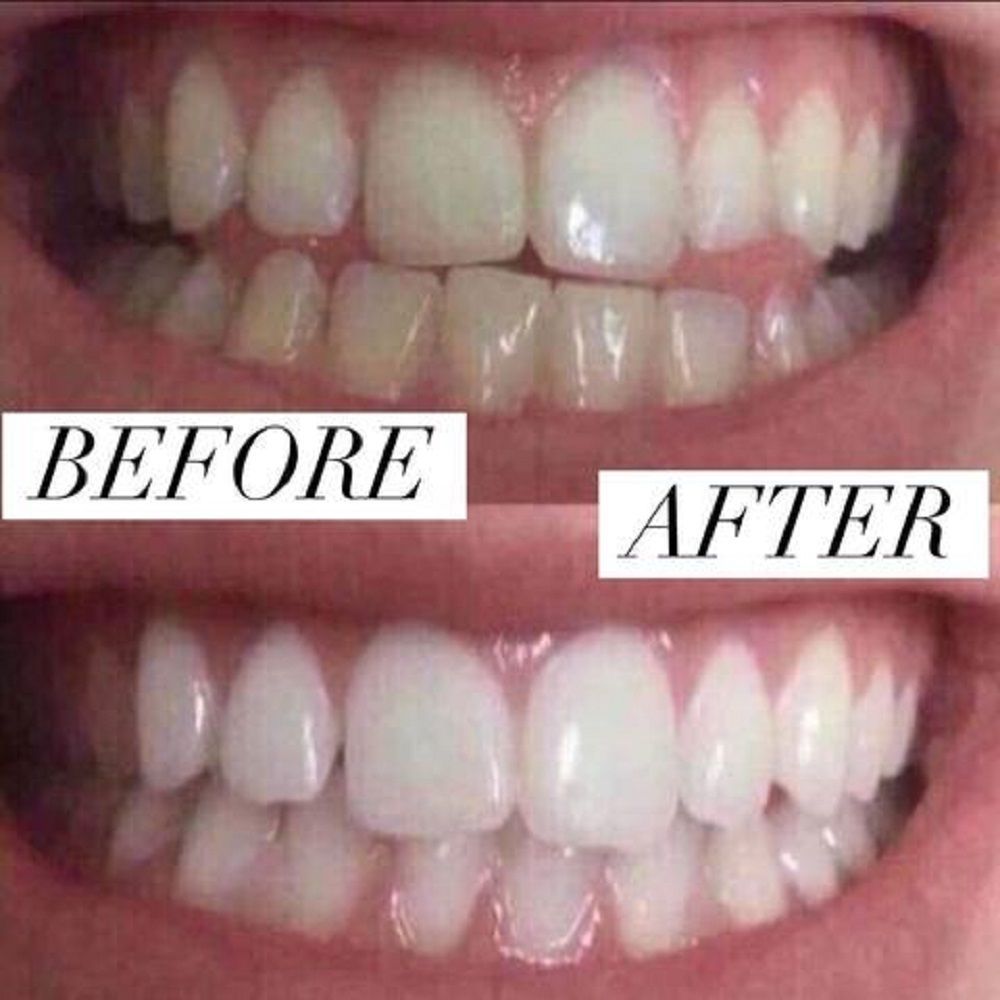 Home Teeth Whitening 3D System and Free Remineralization Gel