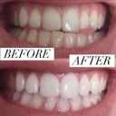  Home Teeth Whitening 3D System and Free Remineralization Gel